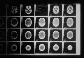 Multiple brain scans displayed side by side, showing different views and sections of the brain
